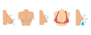 Breast Lift – An Alternative To Breast Implant